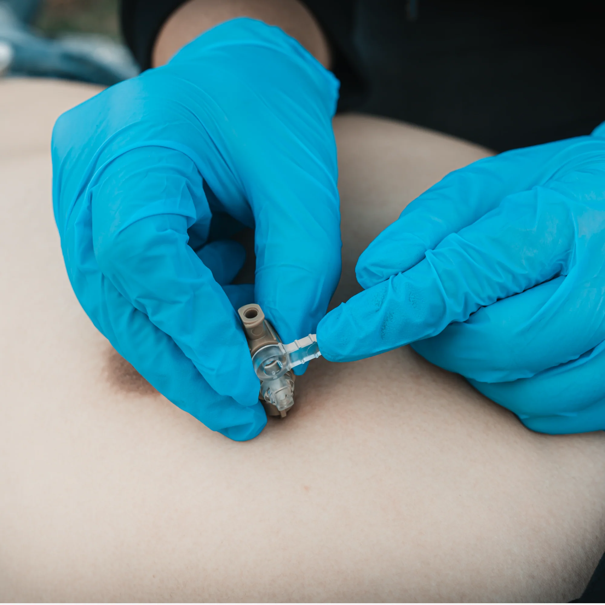 Decompression needle - Image 12