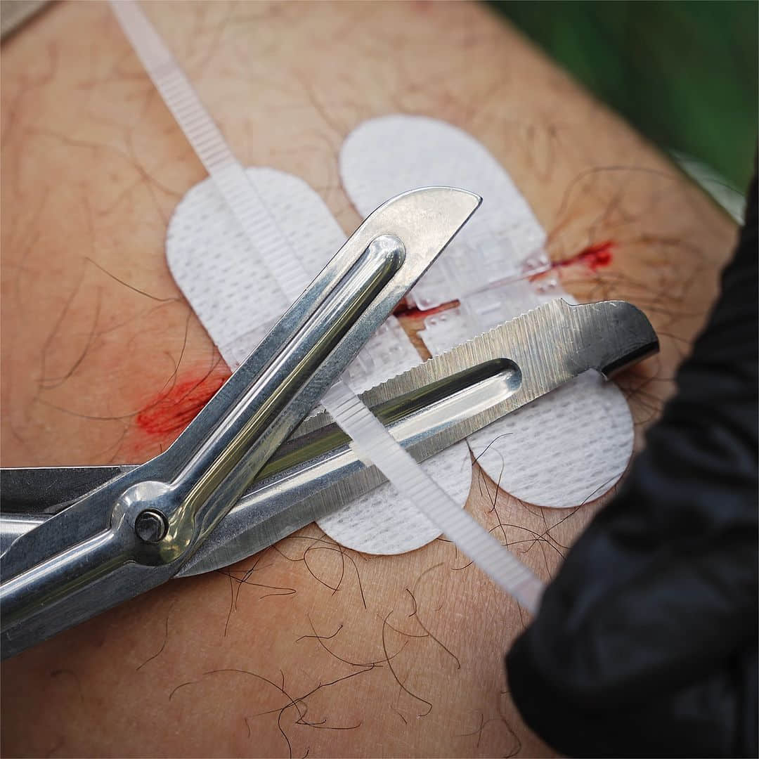 Wound Closure Device - Image 4