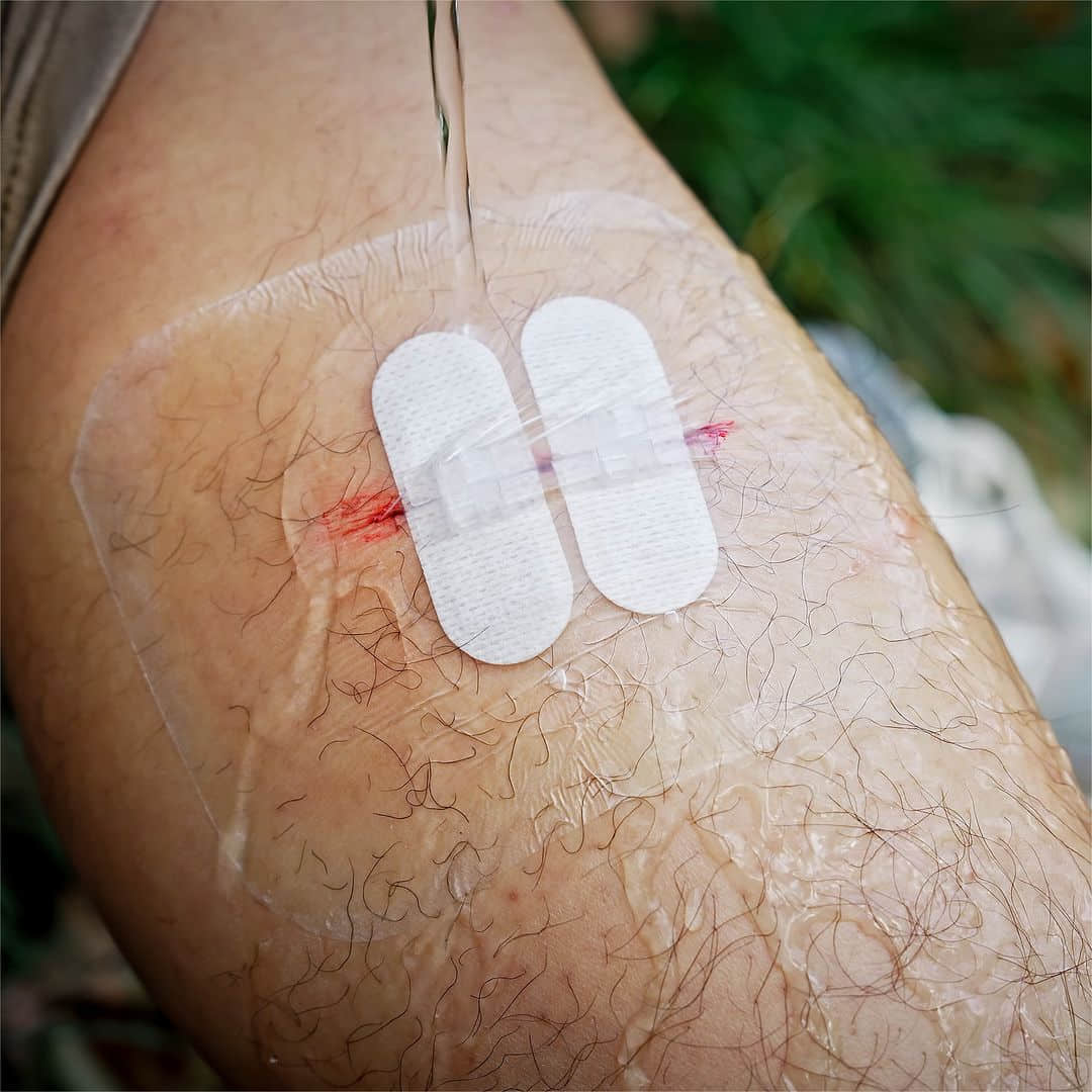 Wound Closure Device - Image 5